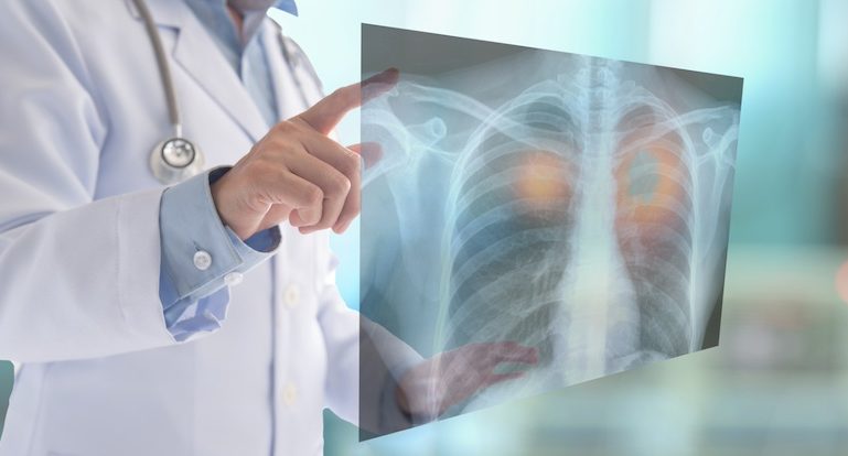 Inhalable point-of-care urinary diagnostic platform